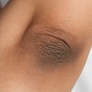 Dark Spots & Uneven Tone