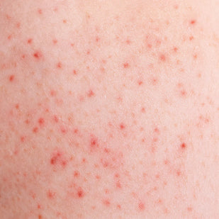 Skin Bumps & Texture