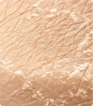 Dull, Rough Skin